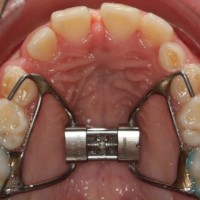 Removable Functional Appliances in Orthodontic Treatment for Dental Laboratory
