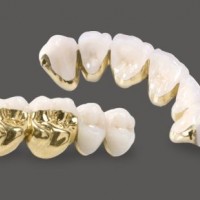 High Intensity Yellow Gold Dental Pfm Crown All Teeth Indication
