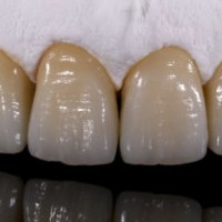 Full Contour Zirconia Dental Crown with CAD / Cam Technology Strong Strength