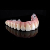 Full Service Dental Implant Restorations Dental Lab