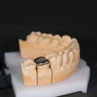 Mer Dental Lab Full Cast Metal Cocr Inlay/Onlay Denture