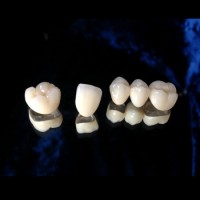 Mer Dental Lab Implant Restorations Pfm Cocr Crown