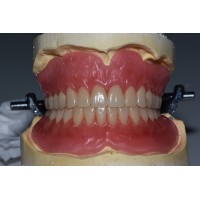 Dental PFM crown from China dental lab